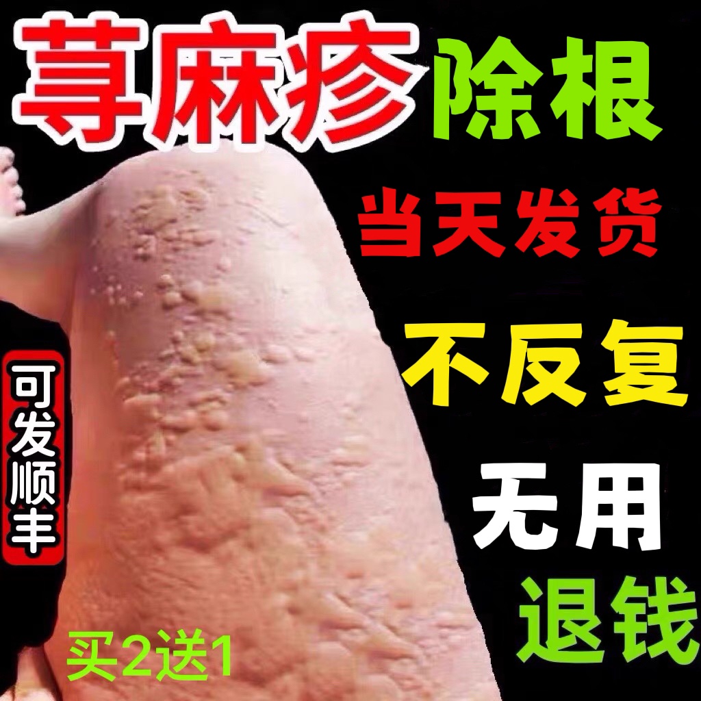 疹性荨麻疹-中国皮肤性病模型-医学