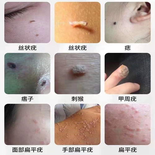 Удаление поверхности плоской бородавки артефактных шелковых бородавок для удаления бородавок, вирусных бородавок Специальные эффекты Специальные эффекты