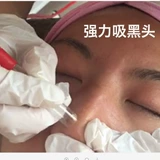 Универсальное косметическое средство для удаления прыщей для лица, очищение пор, для салонов красоты